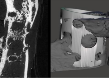 JediCare Medical has announced successful completion of its first-in-human feasibility study of the world’s first-of-its-kind Pulmonary Nodule Percutaneous Sphere Resection