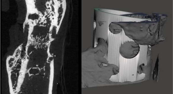 JediCare Medical has announced successful completion of its first-in-human feasibility study of the world’s first-of-its-kind Pulmonary Nodule Percutaneous Sphere Resection