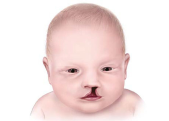 New study reveals how cleft lip and cleft palate can arise