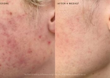 Study of facial bacteria could lead to probiotics that promote healthy skin