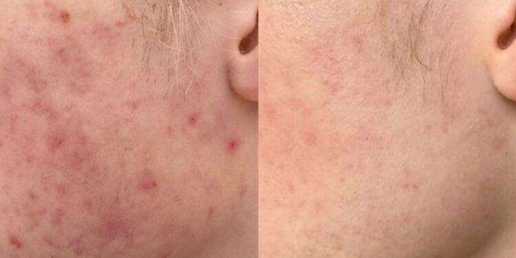 Study of facial bacteria could lead to probiotics that promote healthy skin