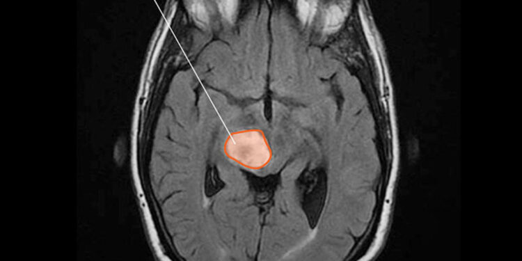 This is your brain without sleep