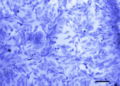 New cell-collection device could improve early cancer detection
